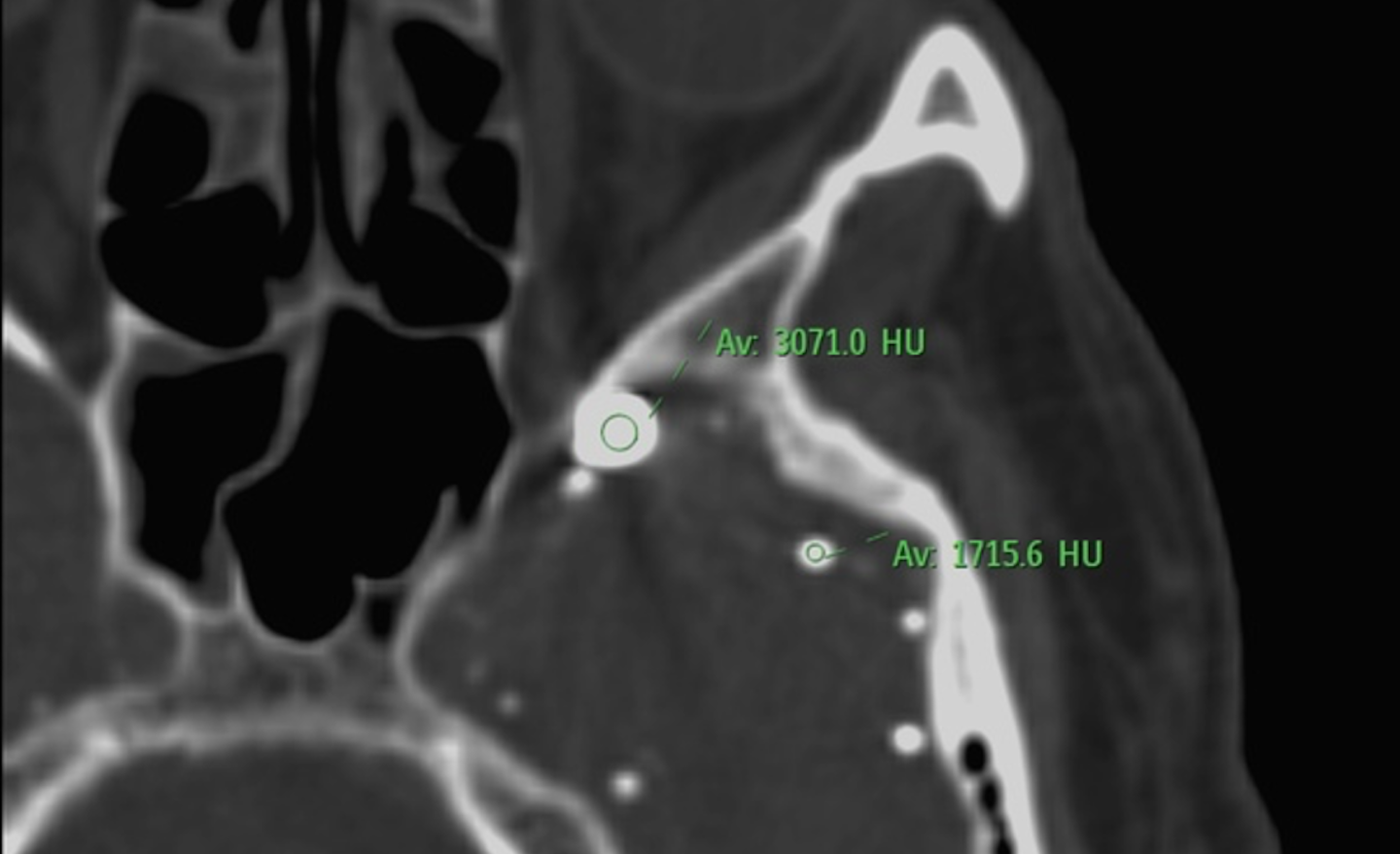 Imagen de artículo REMANENTES DE CONTRASTE INTRATECAL POR TC