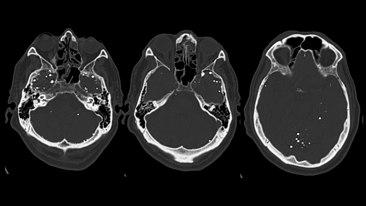 Imagen de artículo REMANENTES DE CONTRASTE INTRATECAL POR TC