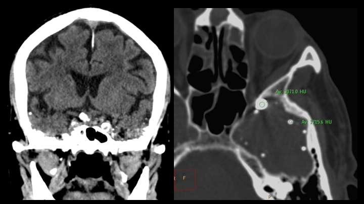 Imagen de artículo REMANENTES DE CONTRASTE INTRATECAL POR TC