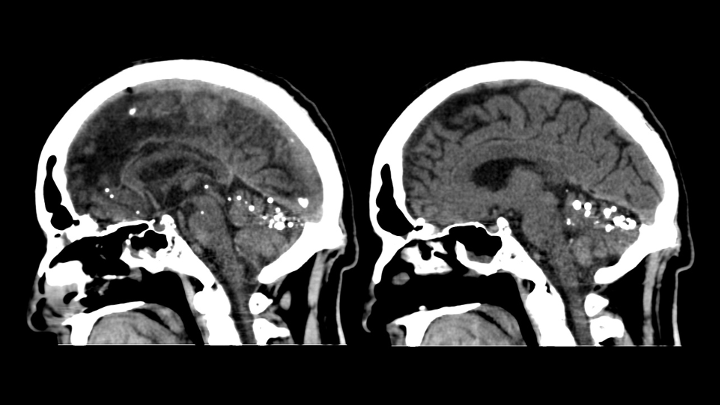 Imagen de artículo REMANENTES DE CONTRASTE INTRATECAL POR TC