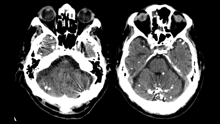 Imagen de artículo REMANENTES DE CONTRASTE INTRATECAL POR TC