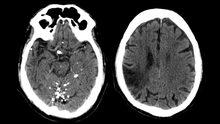 Imagen de artículo REMANENTES DE CONTRASTE INTRATECAL POR TC