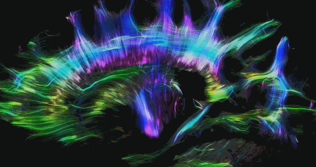 Imagen de artículo RESONANCIA MAGNÉTICA FUNCIONAL EN REPOSO